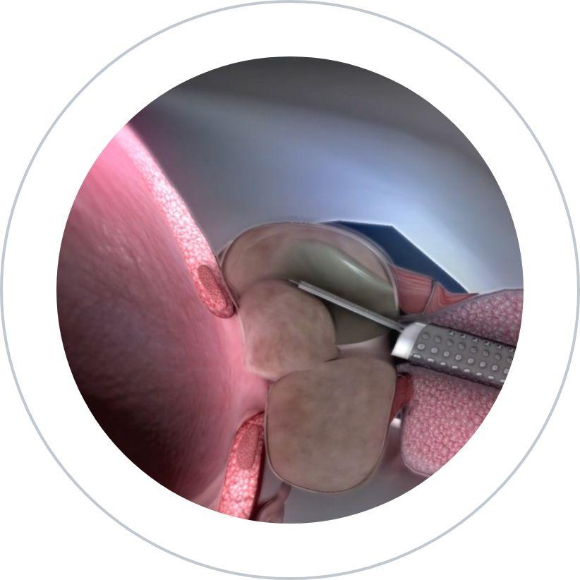obtención de imágenes 3d para diagnosticar cáncer de próstata