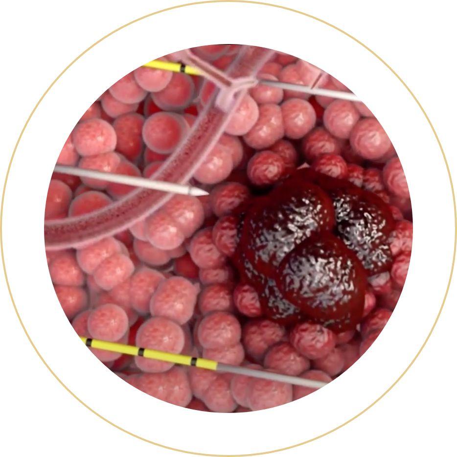 tratamiento de terapia focal para el cáncer de próstata