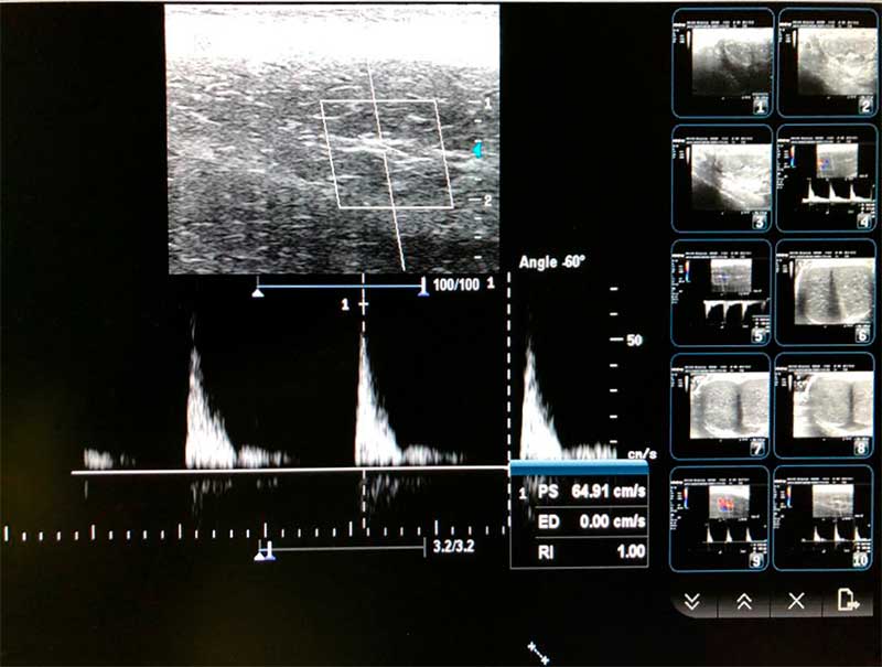 estudio-vascular-pene