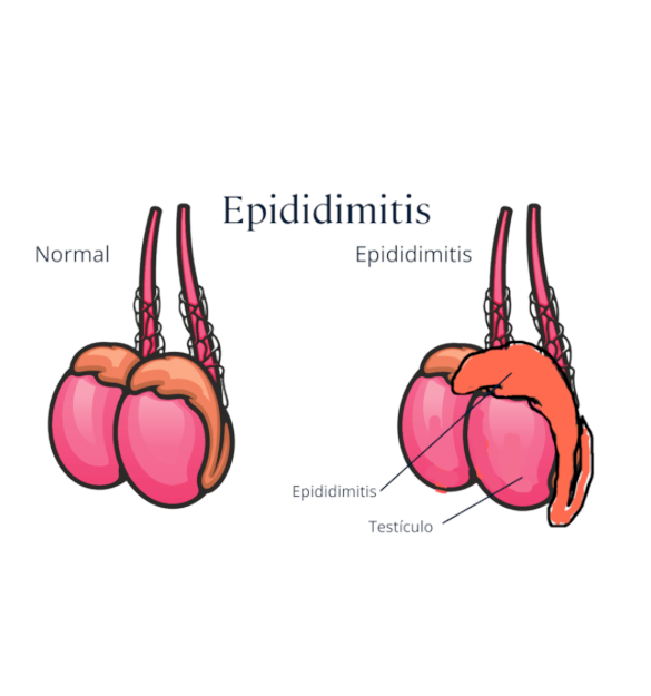 Epidermitis