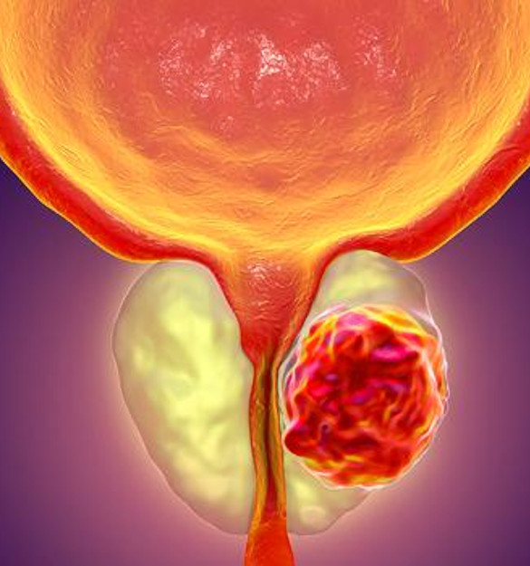 Reseccion-transuretral-de-prostata