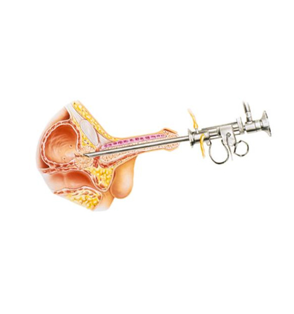 Reseccion-transuretral-de-prostata