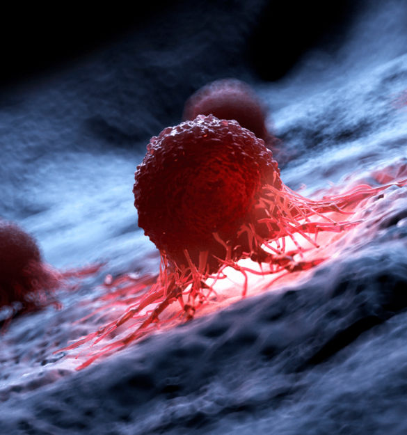 Cancer-de-vejiga-con-metastasis