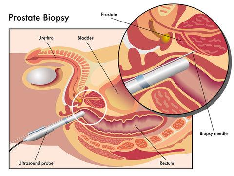 Biopsia-de-próstata