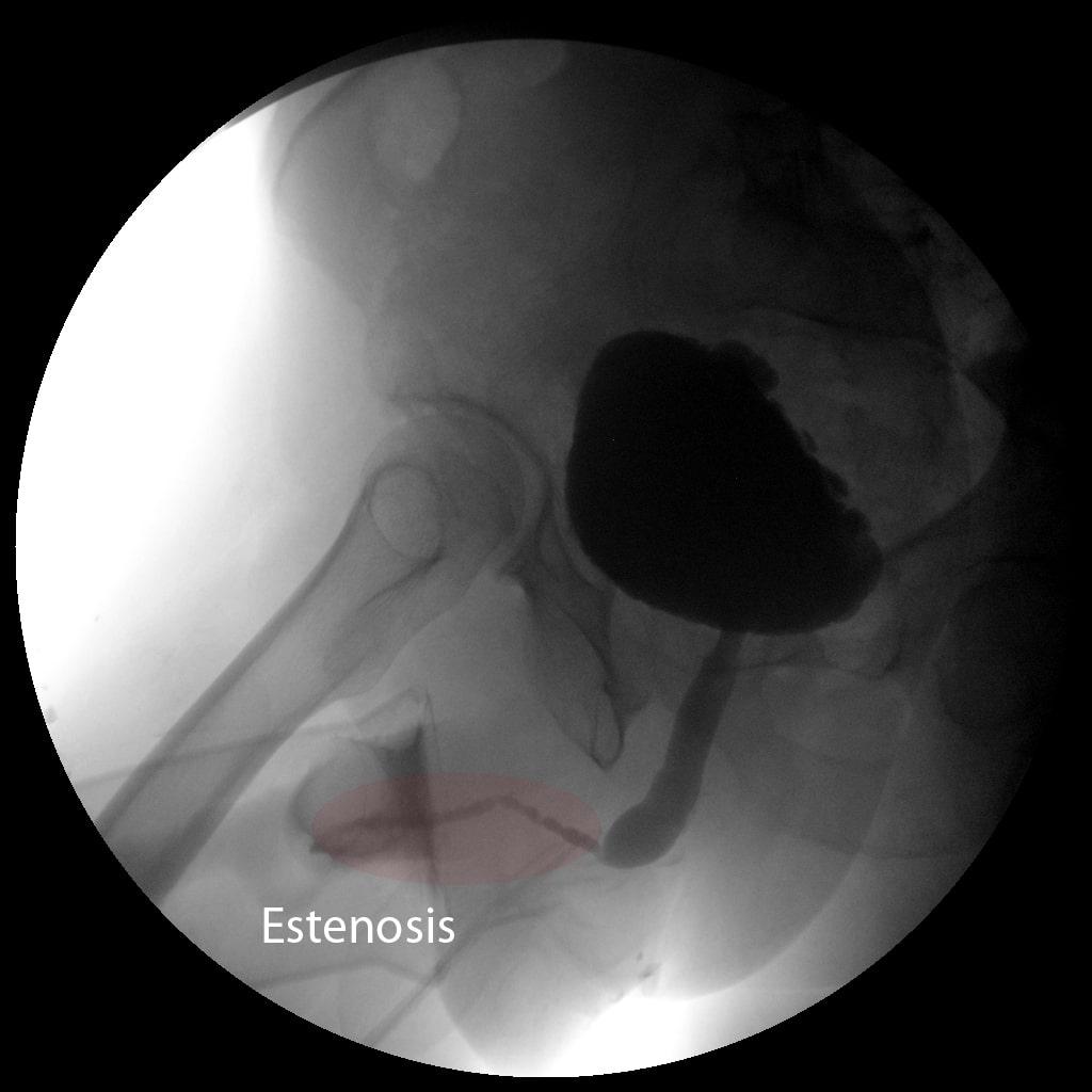 cirugia-estenosis-uretral